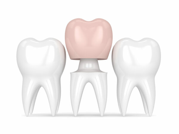 dental crowns Elim Dental dentist in Mt Kisco New York Dr. Jin Sub Oh dds